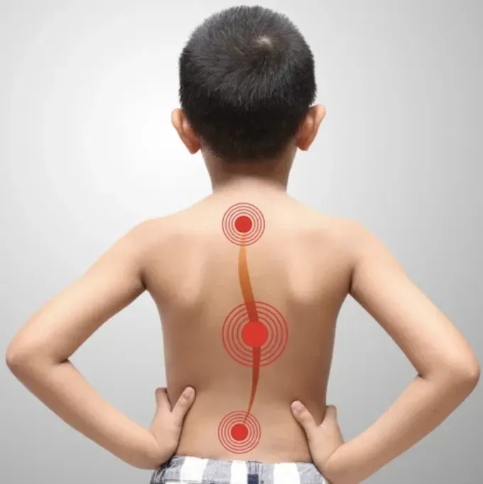 Scoliose chez l'enfant : pourquoi un diagnostic précoce est crucial ?